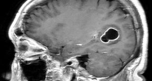 El hombre con migrañas al que médicos en EE UU le encontraron larvas en el cerebro por comer carne de cerdo poco cocida