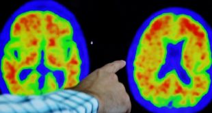 El fármaco contra el Alzheimer de Eisai y Biogen sufre un revés en Europa