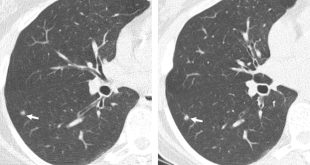 Resonancia donde se muestra la evolución de un cáncer de pulmón.