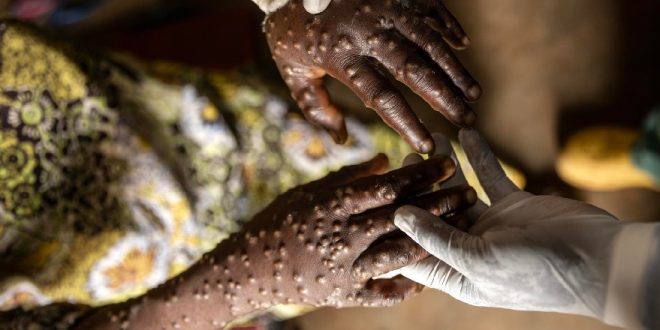 WHO maintains the international emergency for the MPOX in the face of the growing number of cases