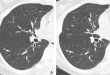 Resonancia donde se muestra la evolución de un cáncer de pulmón.